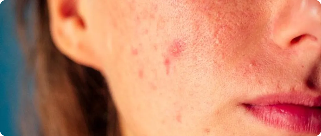 Papules acne