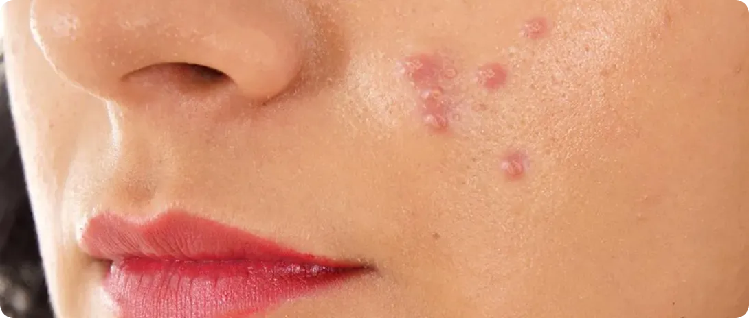 Pustules Acne