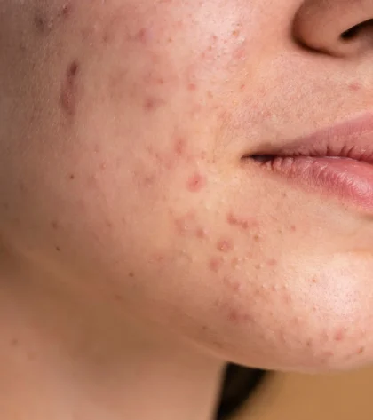 Acne Before Treatment