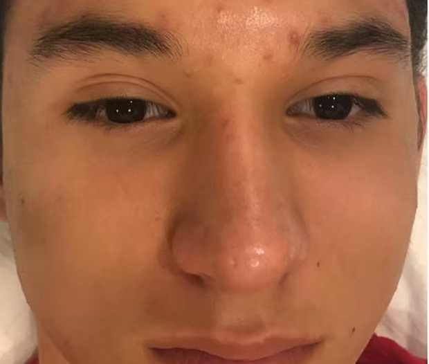 Acne Before