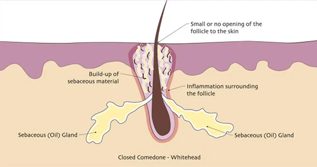 Acne-closed-comedone
