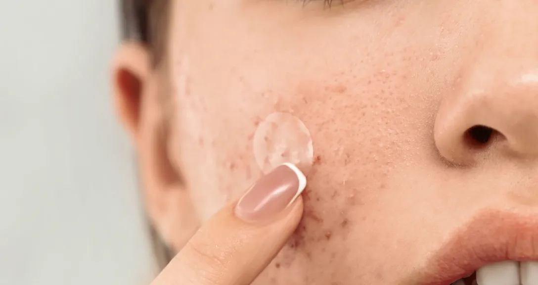 acne cure by paste webp