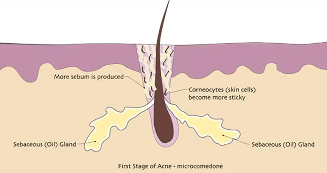 Acne First Stage