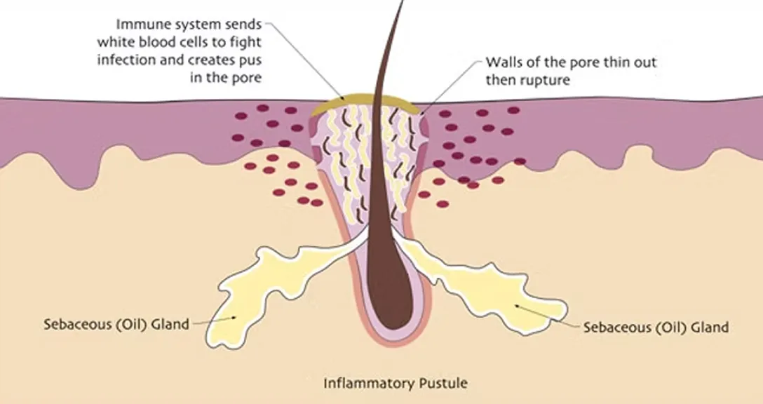 Acne-inflammatory-pustle