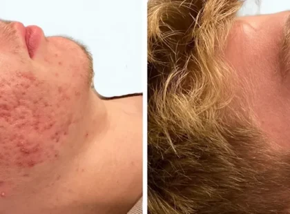 Acne-keep-coming-back