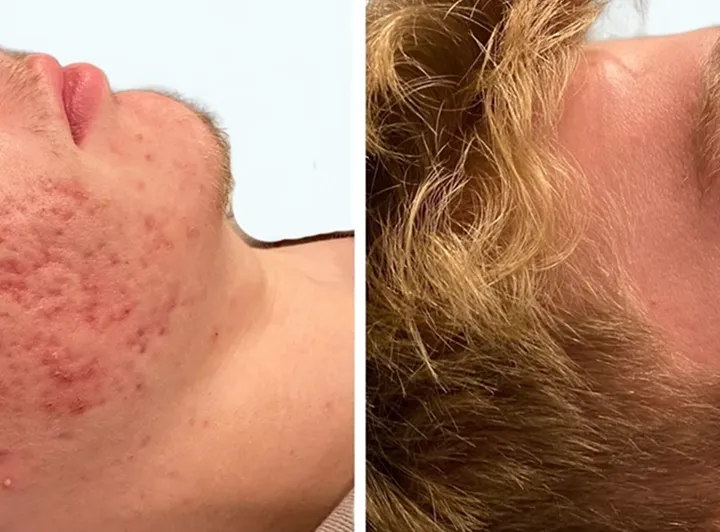 Acne-keep-coming-back