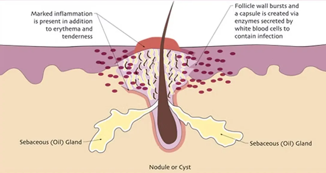 Acne-nodule-stage