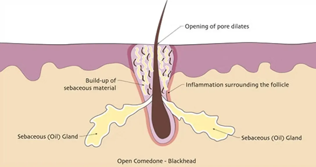 Acne open comedone