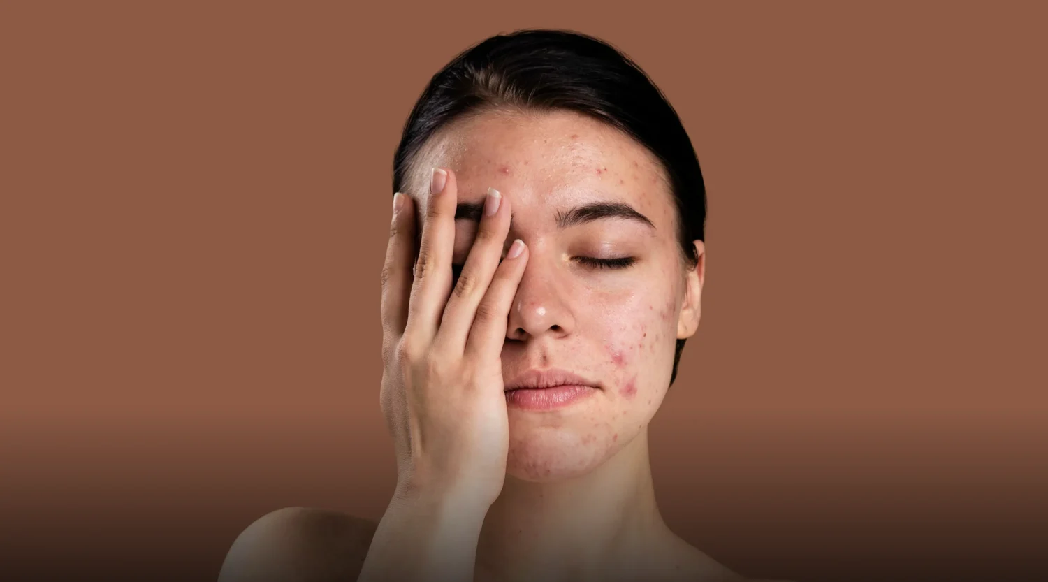 Acne-treatment-service-banner