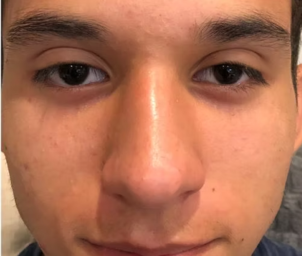 After Treatment