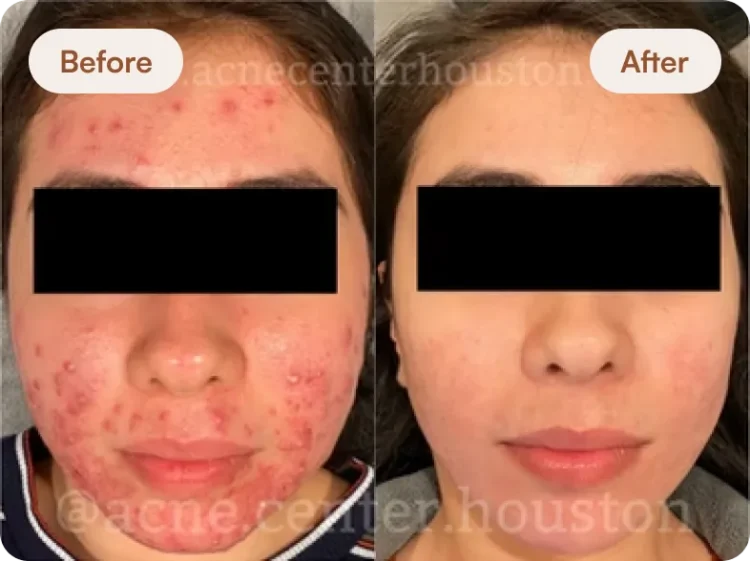 Before After 1