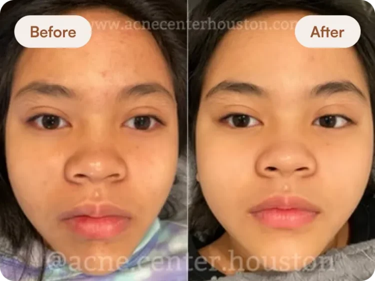Before After 2
