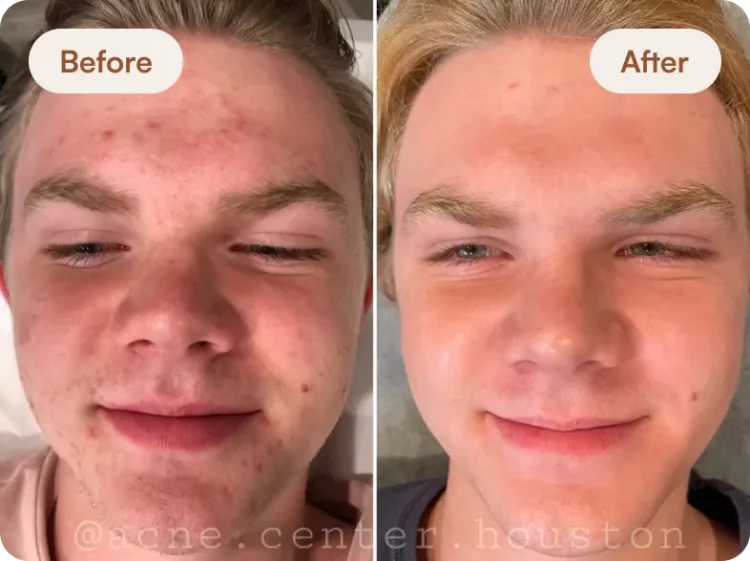 Before After 3