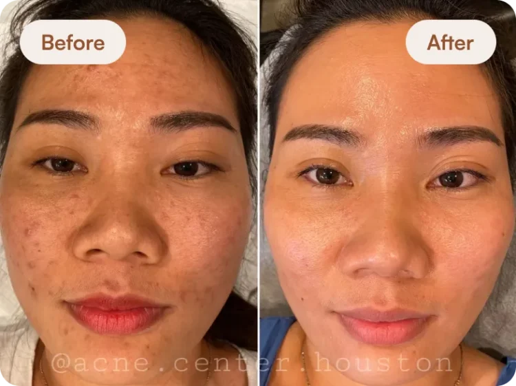 Before After 6
