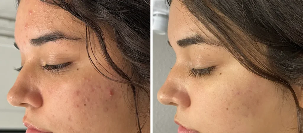 comedonal-acne