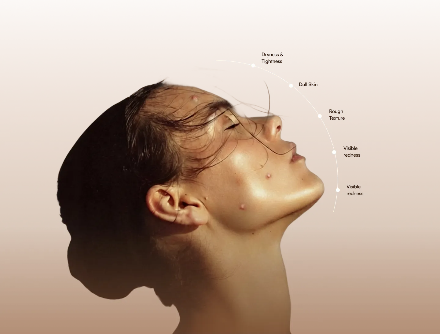 cystic acne