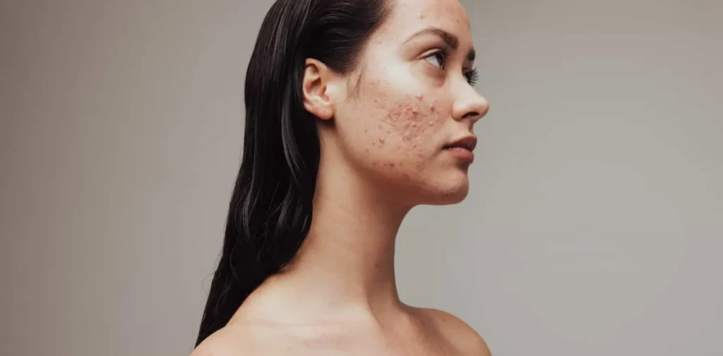 Cystic acne image 1