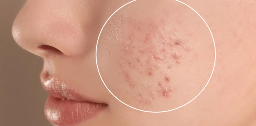 Cystic acne image 2