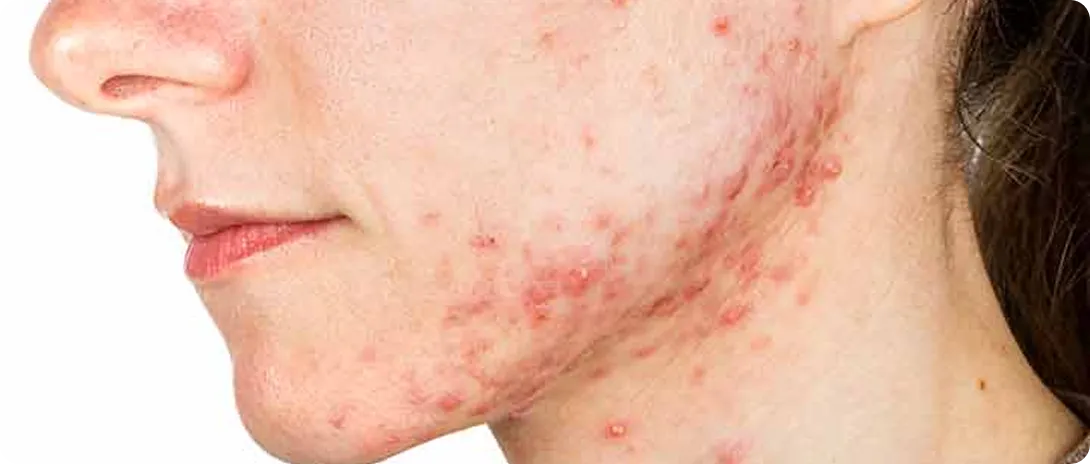 Cystic Acne