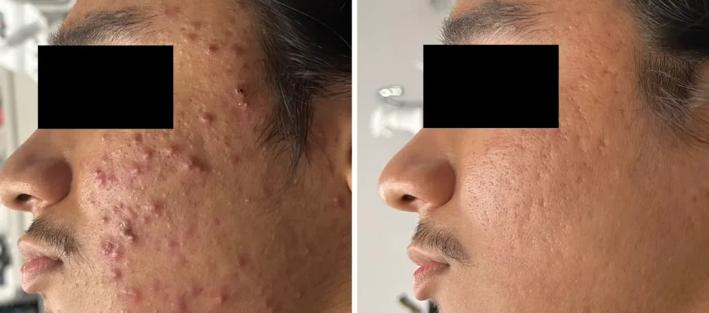 inflammatory-acne-blog