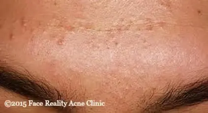 Acne-Mechanica