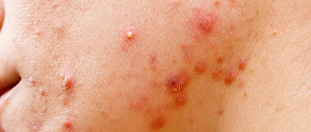 Nodules Acne