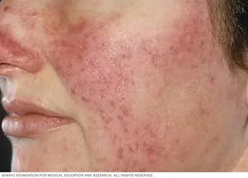 Rosacea-Acne