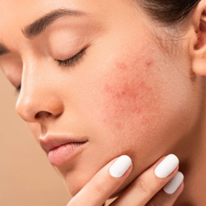 Acne-pro-skin