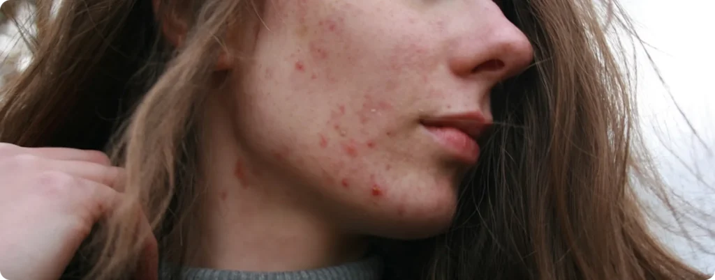 acne - issue -teen