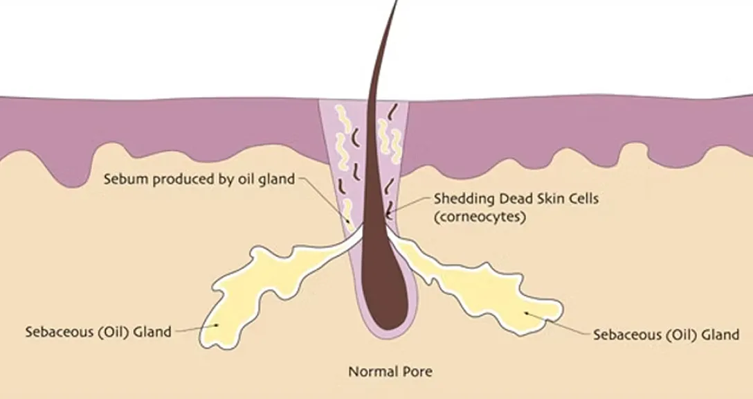 What is acne