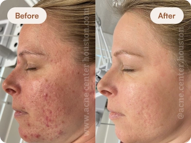 Acne_Before_After_1