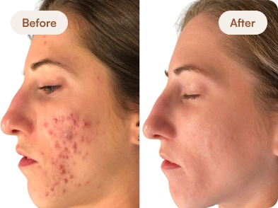 Acne_Before_After_10