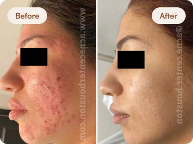 Acne_Before_After_11