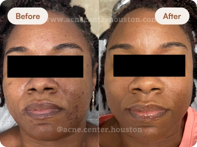 Acne_Before_After_12