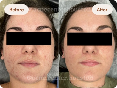 Acne_Before_After_13