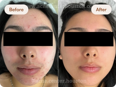 Acne_Before_After_14
