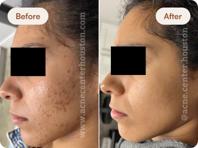 Acne_Before_After_15