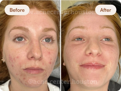 Acne_Before_After_16