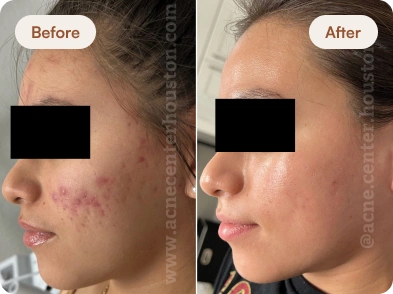 Acne_Before_After_17
