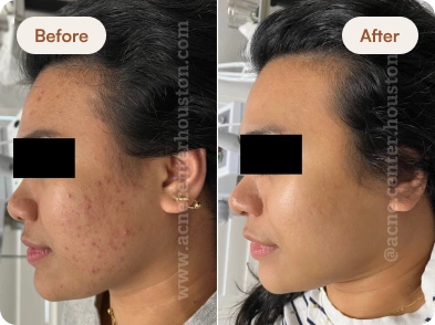 Acne_Before_After_18