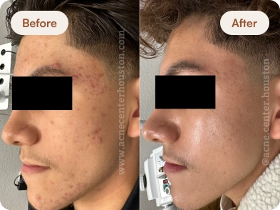Acne_Before_After_19