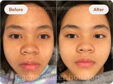 Acne_Before_After_2