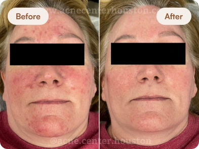 Acne_Before_After_20