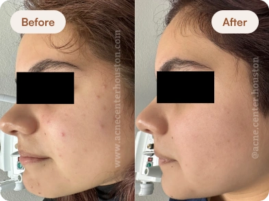 Acne_Before_After_21
