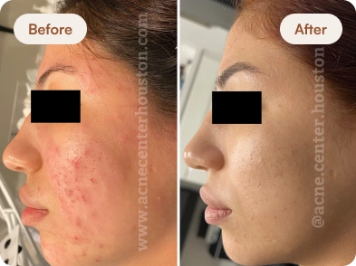 Acne_Before_After_22