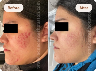 Acne_Before_After_23