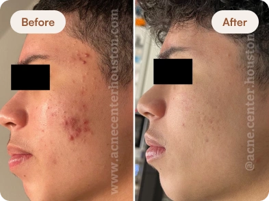 Acne_Before_After_24