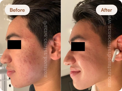 Acne_Before_After_25