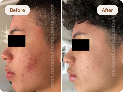 Acne_Before_After_26