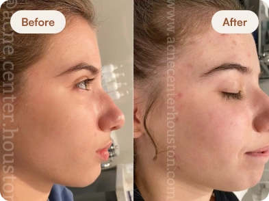 Acne_Before_After_4